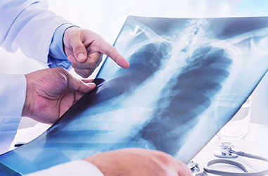 Mesothelioma Lung Cancer Lawsuit